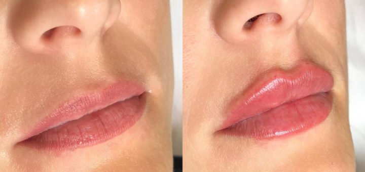 Обзор увеличения губ филлерами в клинике «Реформа»